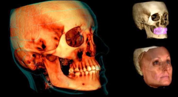 L'efficacité du protocole d'imagerie Planmeca Ultra Low Dose™ est scientifiquement prouvée