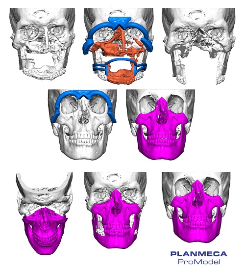 Planmeca ProModel™ a fait partie de la première procédure de greffe de tissu facial dans les pays nordiques