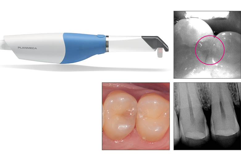 Detect caries with Planmeca Cariosity® scanning tip for Planmeca Emerald® intraoral scanners