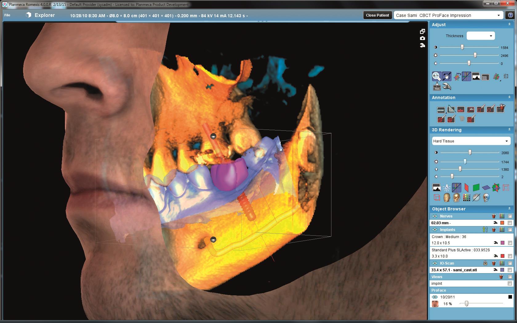 Planmeca Romexis® – CAD/CAM work and CBCT data in one software