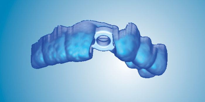 Planmeca Romexis® Implant Guide module completes a fully digital implant workflow