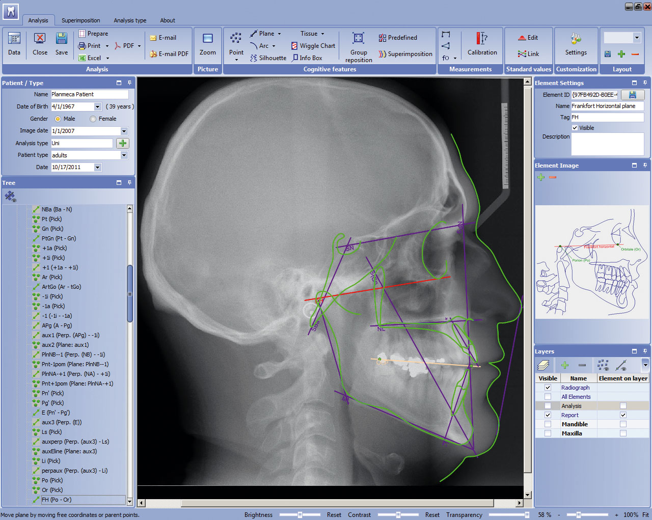 Planmeca introduces a new analysis tool for planning orthodontic treatments