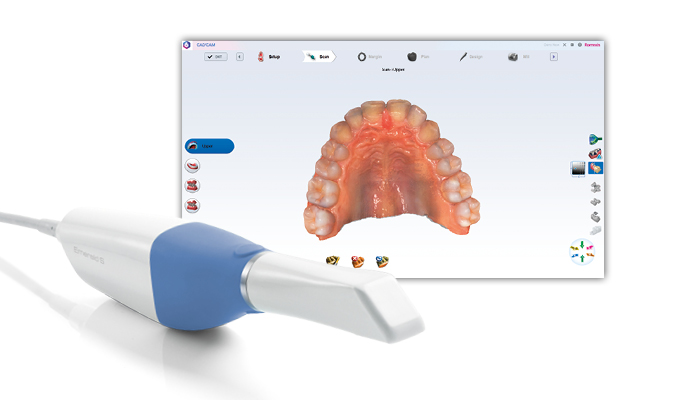 Planmeca Emerald™ S - Hochgeschwindigkeits-Intraoralscanner für nahtlose digitale Arbeitsabläufe