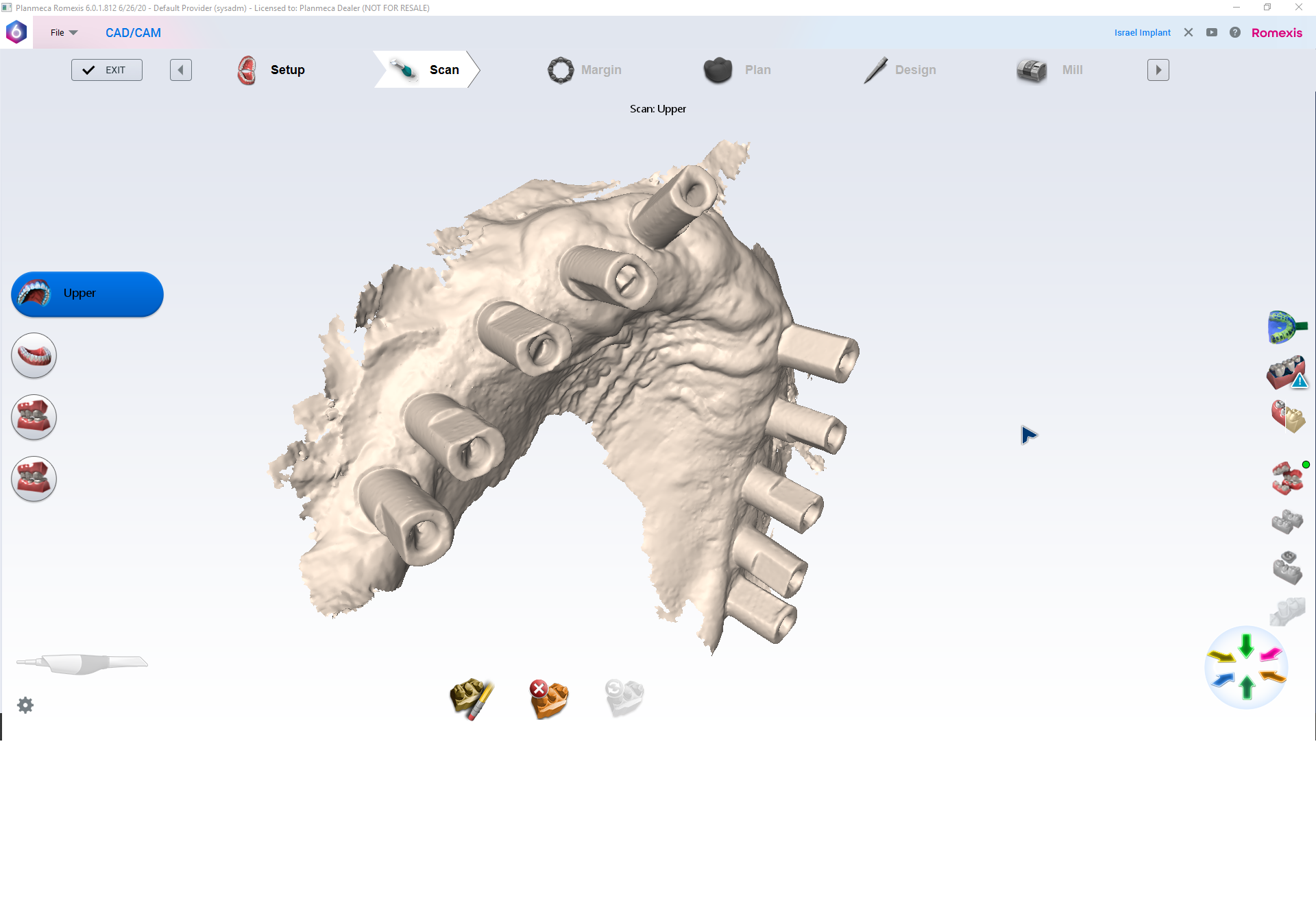Case report: Using digital impressions of the upper jaw for a full-arch dental bridge treatment