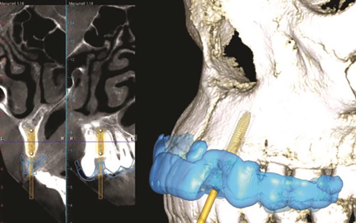 Case report: The complete digital implant workflow