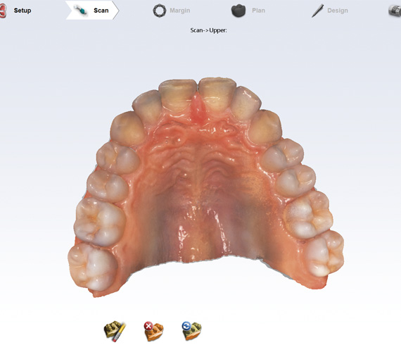 Planmeca intraoral scanner for fast and accurate scanning