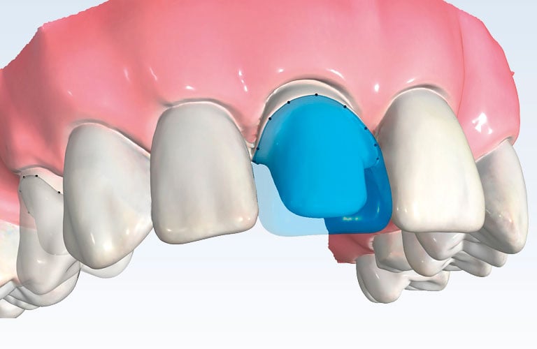 Dental CAD/CAM software | Planmeca