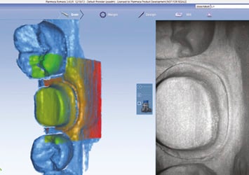 Workflow with Planmeca Romexis Compare Scan