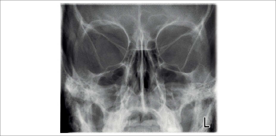 ProMax 2D 2S clinical images PA sinus