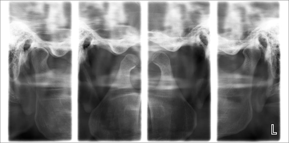 ProMax 2D clinical images lateral TMJ