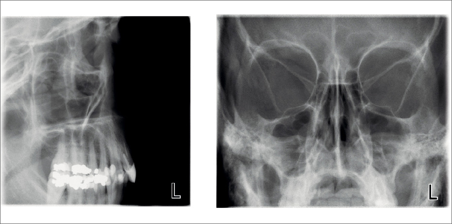 ProMax 2D S3 clinical images Lateral and PA sinus