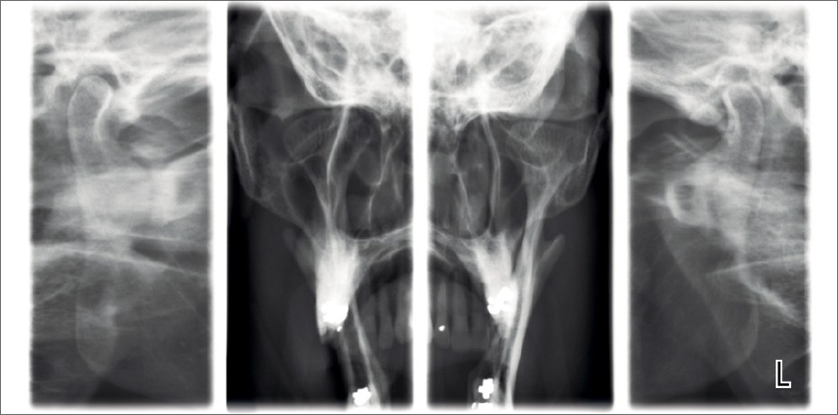 ProMax 2D S3 clinical images lateral PA TMJ