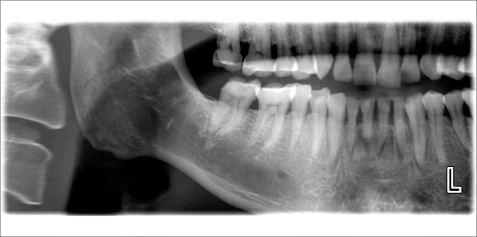 Planmeca ProOne horizontal and vertical segmenting for panoramic program