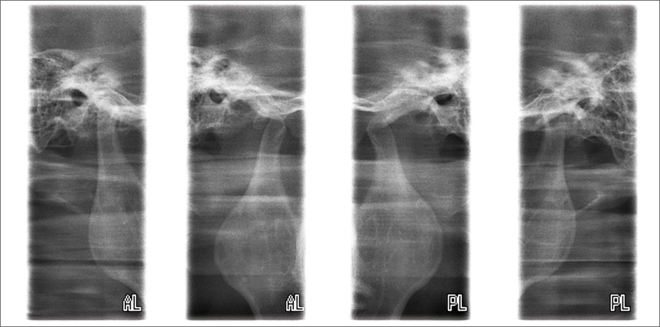 Planmeca ProOne lateral TMJ