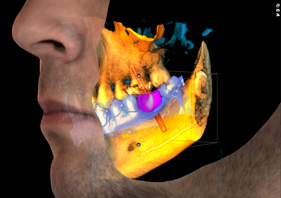 Promax 3D Classic 3 x 3D = CBCT + ProFace + impression scan