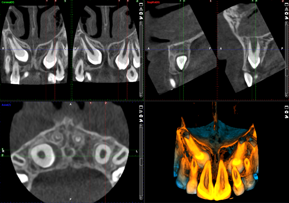 Promax 3D Classic impacted canine