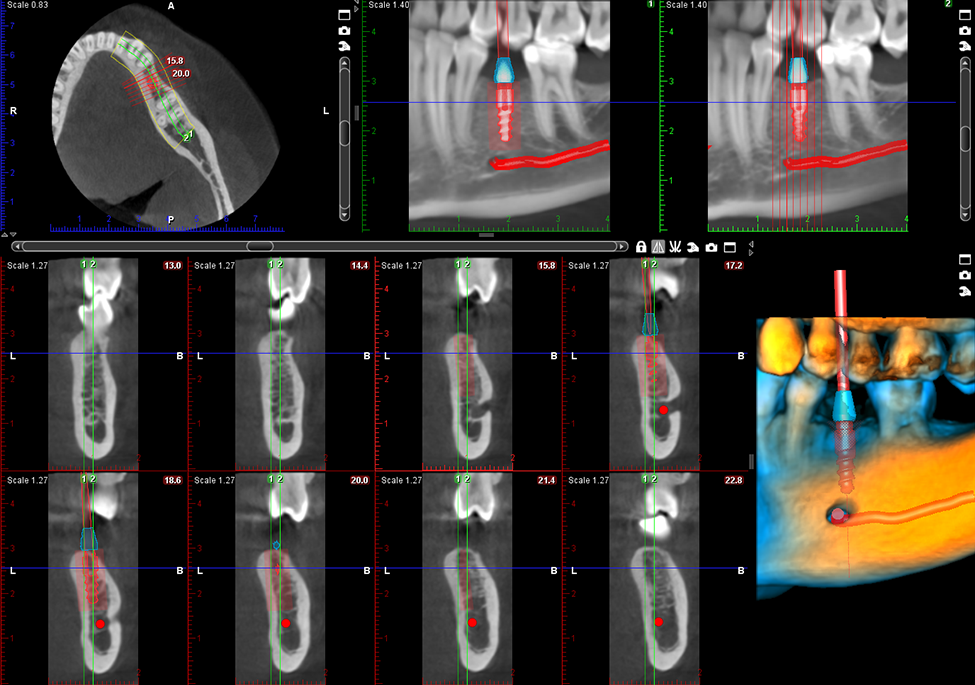 Promax 3D Classic implant case