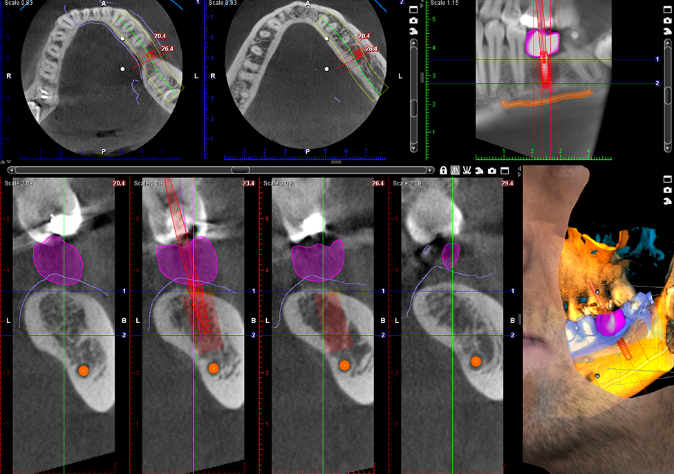 Promax 3D Classic implant with crown