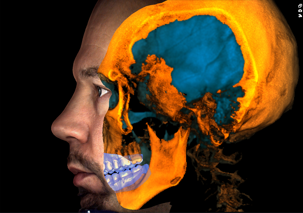 3 x 3D = CBCT + ProFace + impression scan