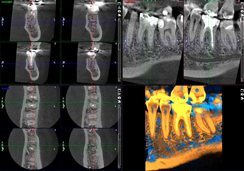ProMax 3D Max endodontic case