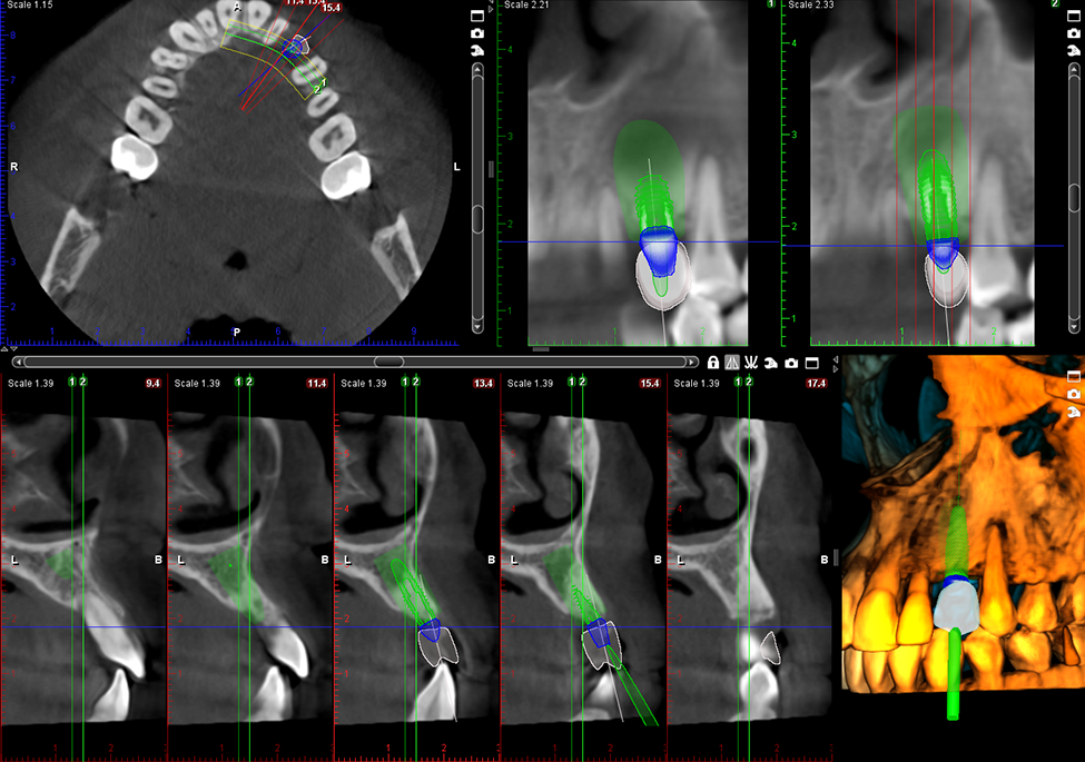 ProMax 3D Max Implant planning