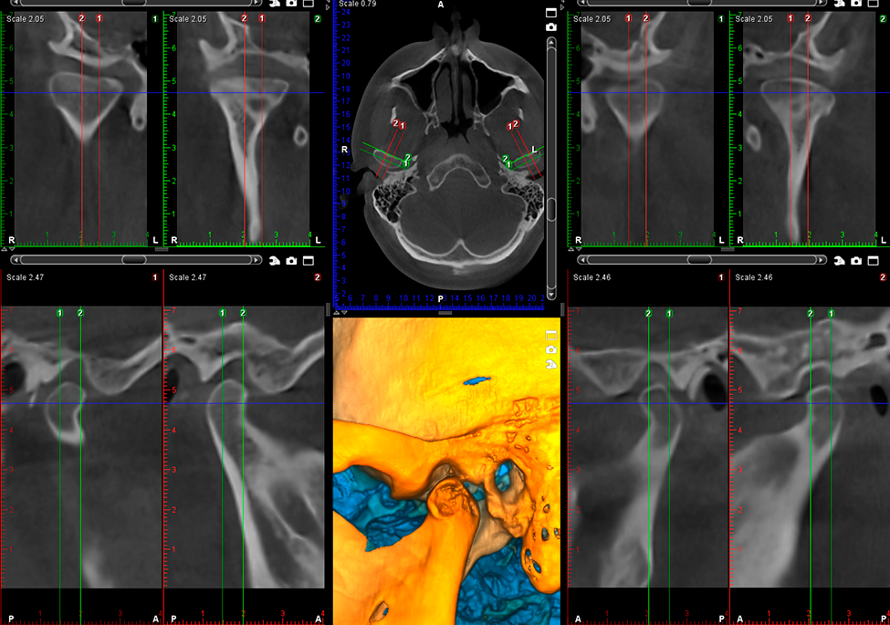 ProMax 3D Max TMJ study