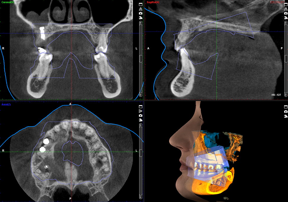 3 x 3D = CBCT + ProFace + impression scan