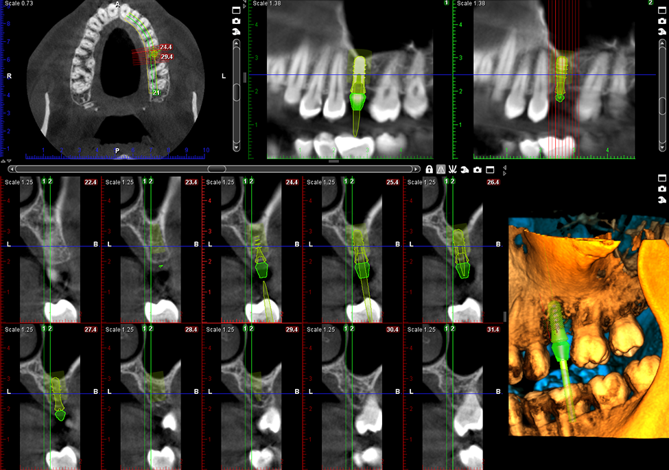 3 x 3D = CBCT + ProFace + impression scan