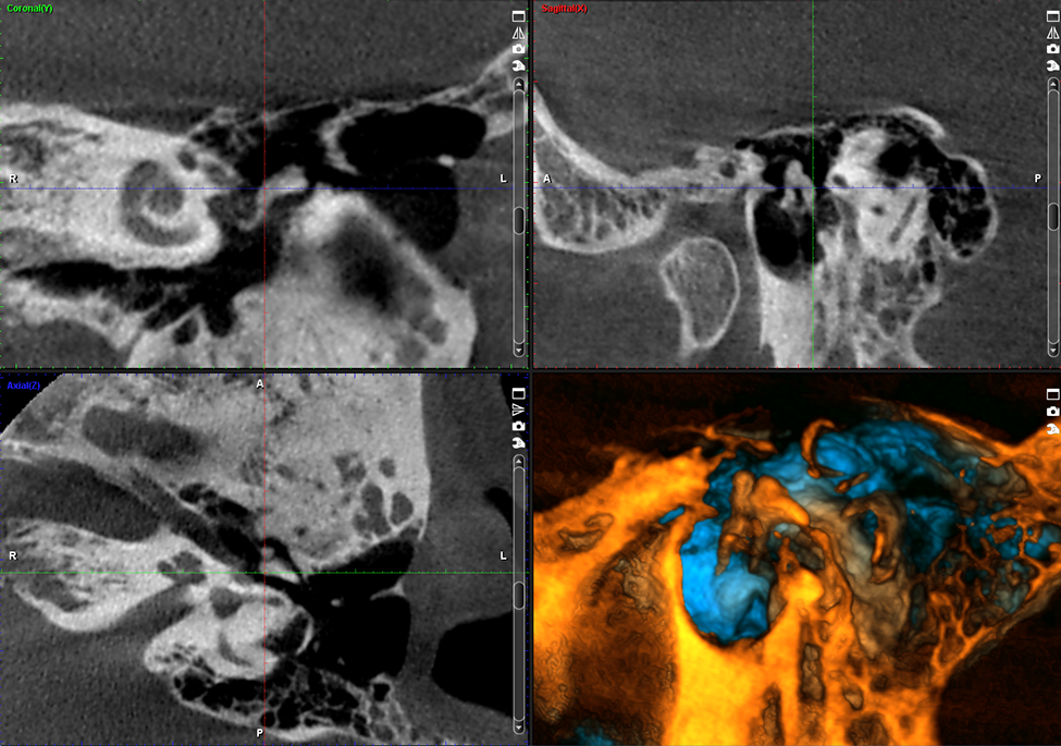 ProMax 3D Mid Middle ear 3D image