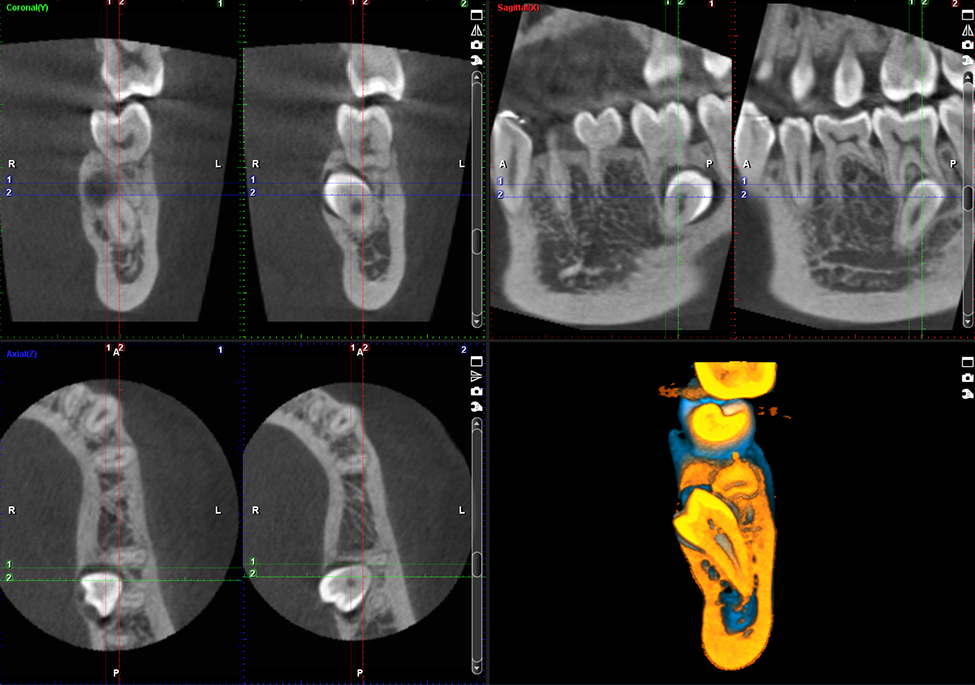 ProMax 3D Mid Retired premolar