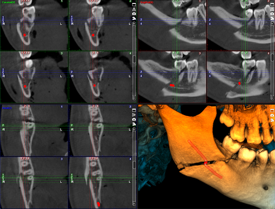 ProMax 3D Mid surgical case