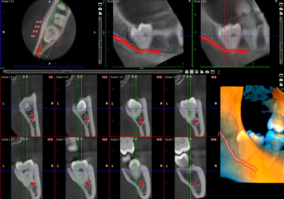 ProMax 3D Mid wisdom toot extraction
