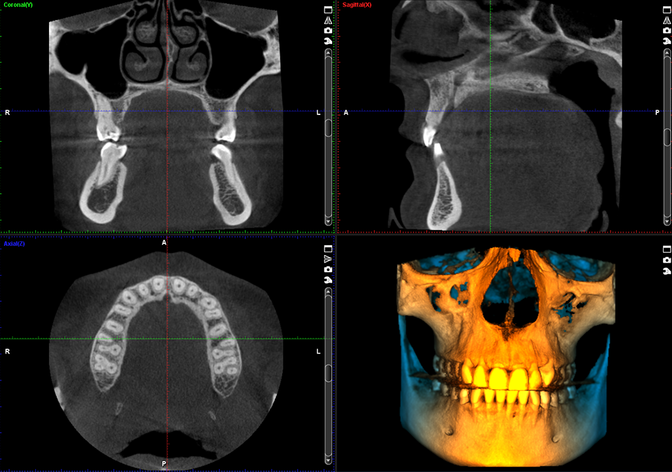 ProMax 3D Plus 9x9 volume