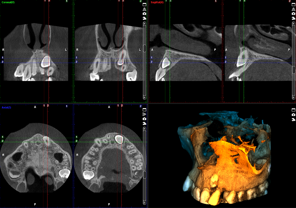 ProMax 3D Plus middle ear
