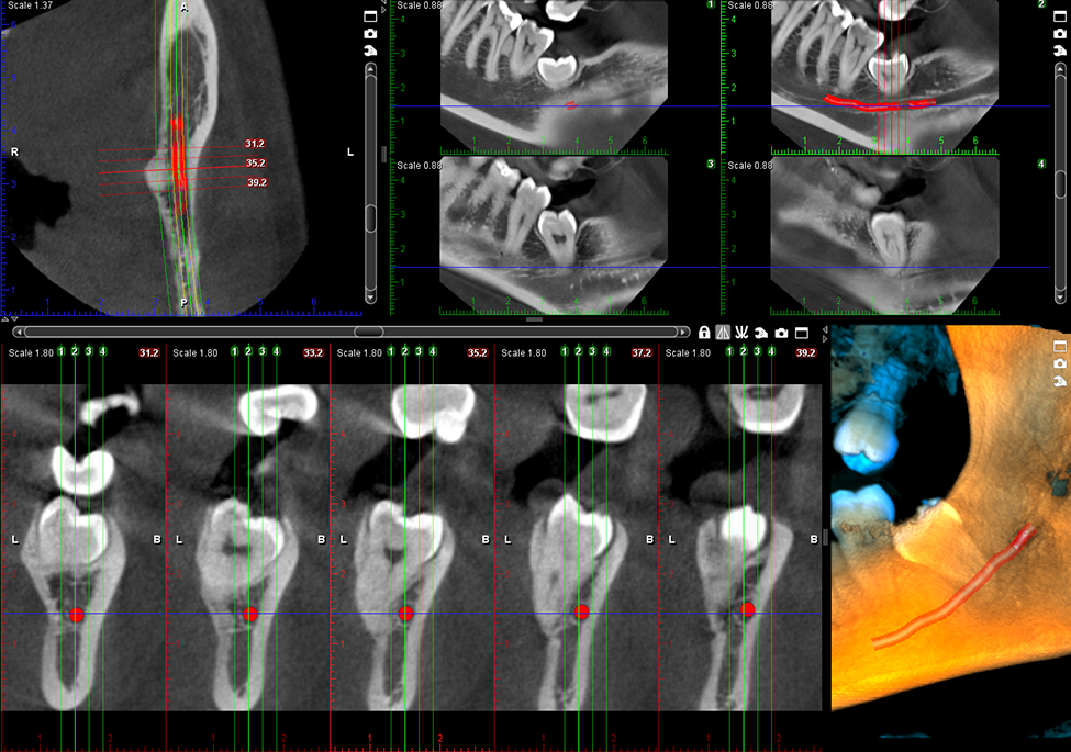 ProMax 3D Plus middle ear