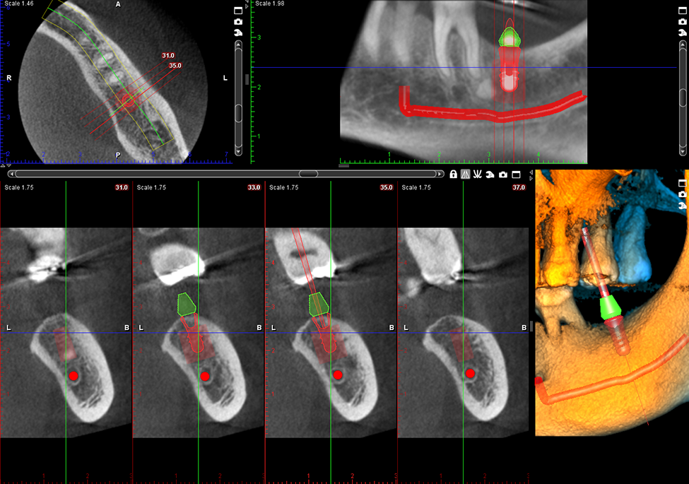 Planmeca ProMax 3D s implant planning