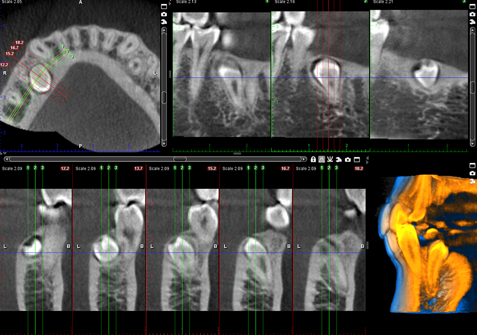 Planmeca ProMac 3D s orthodontic case