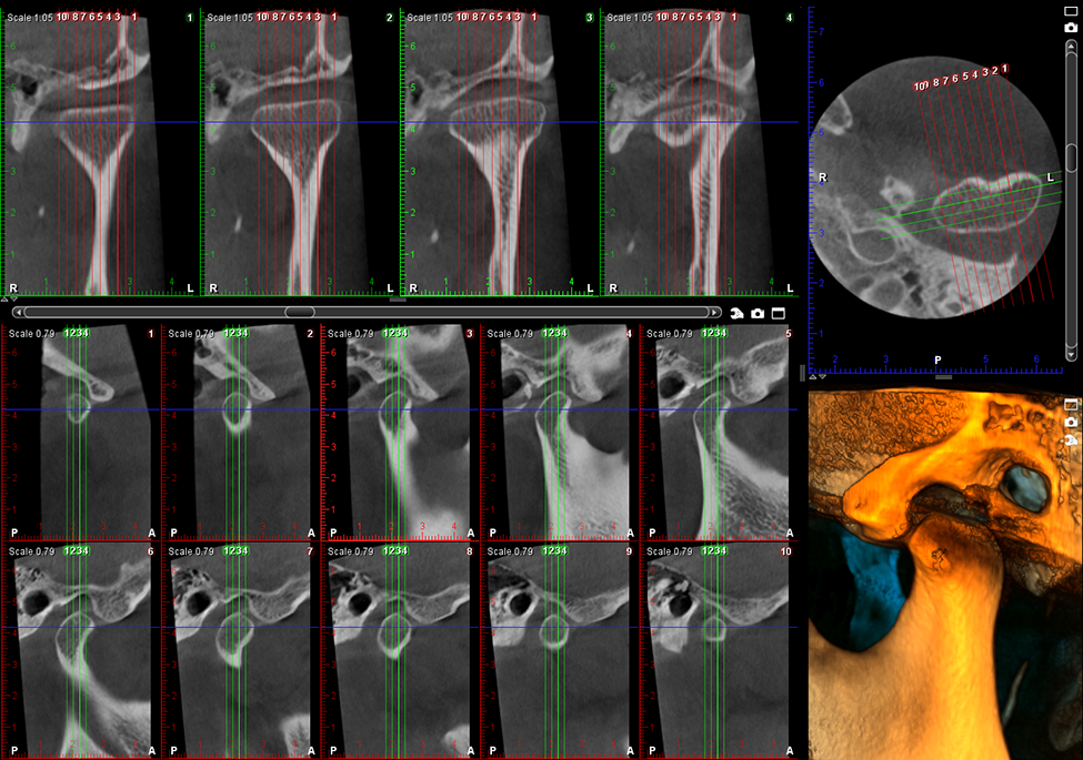 Planmeca ProMax 3D s TMJ study