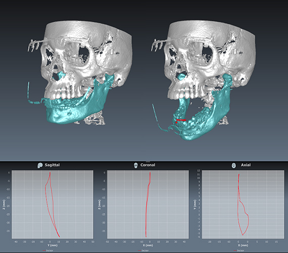Innovative jaw movement tracking Planmeca 4D Jaw Motion