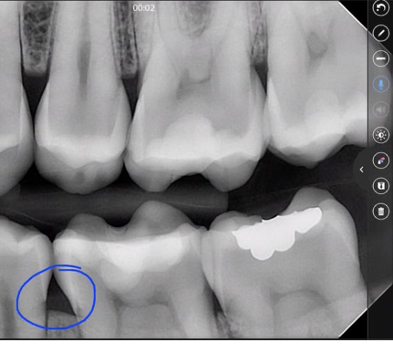 Planmeca mRomexis voice annotations