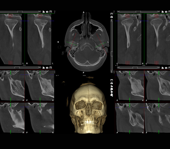 Planmeca Romexis TMJ views