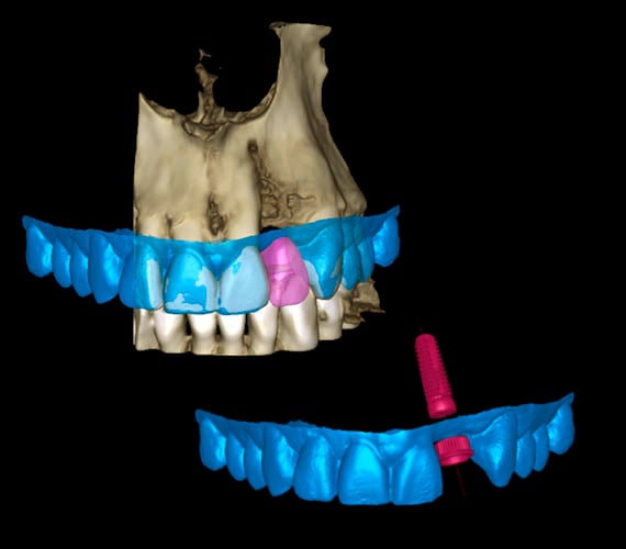 Planmeca Romexis 3D implant planning