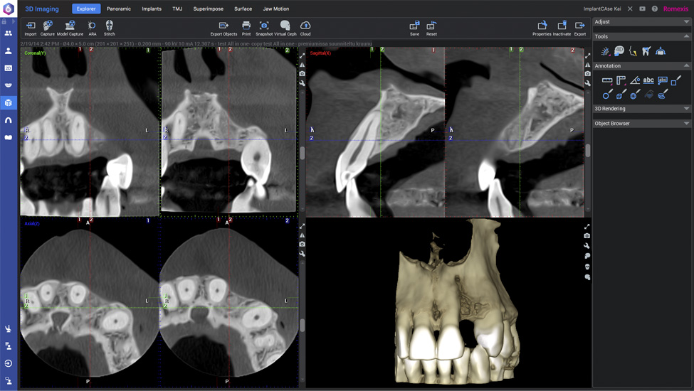 Planmeca Romexis implant workflow step 2