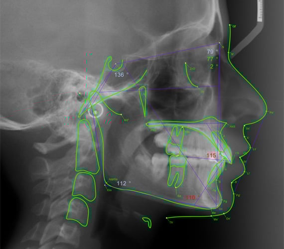 Tracé céphalométrique