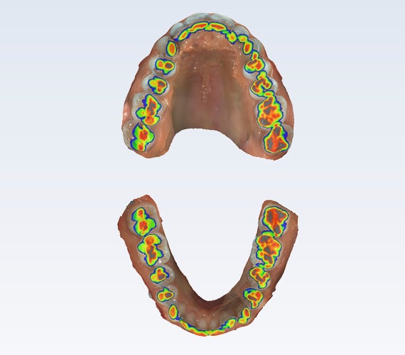 Planmeca Romexis model analyser clear