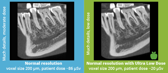 Planmeca Ultra Low Dose