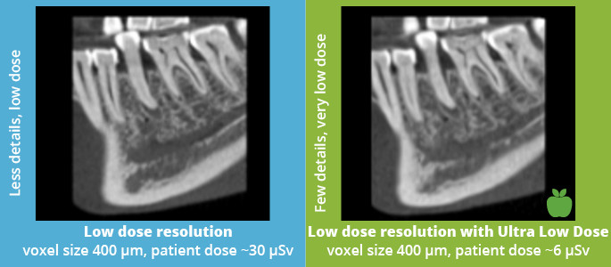 Planmeca Ultra Low Dose