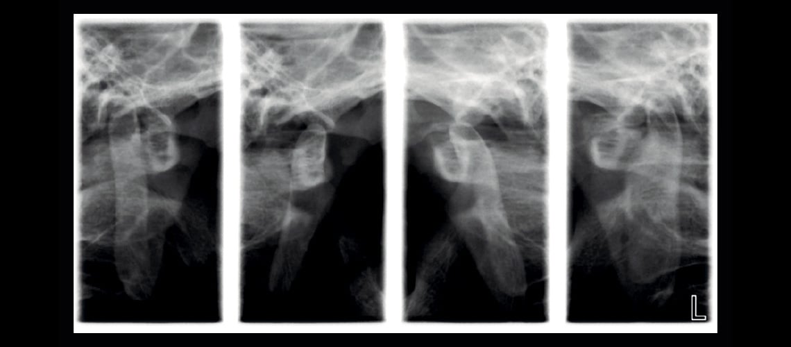 Lateral TMJ (closed & open)