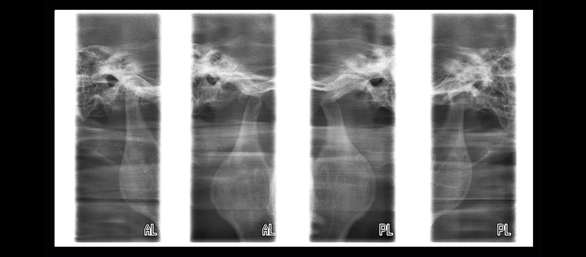 Lateral TMJ