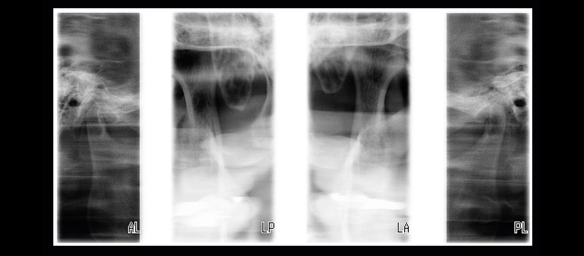 Lateral-PA TMJ